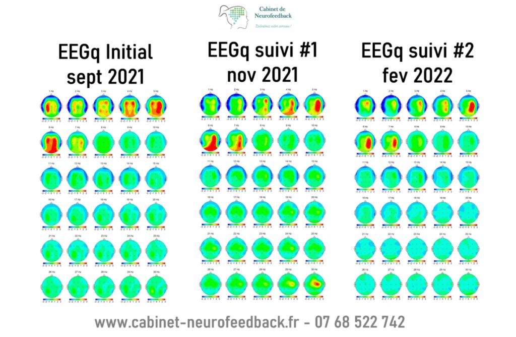 Bilan cérébral EEGq : électroencéphalogramme quantitatif