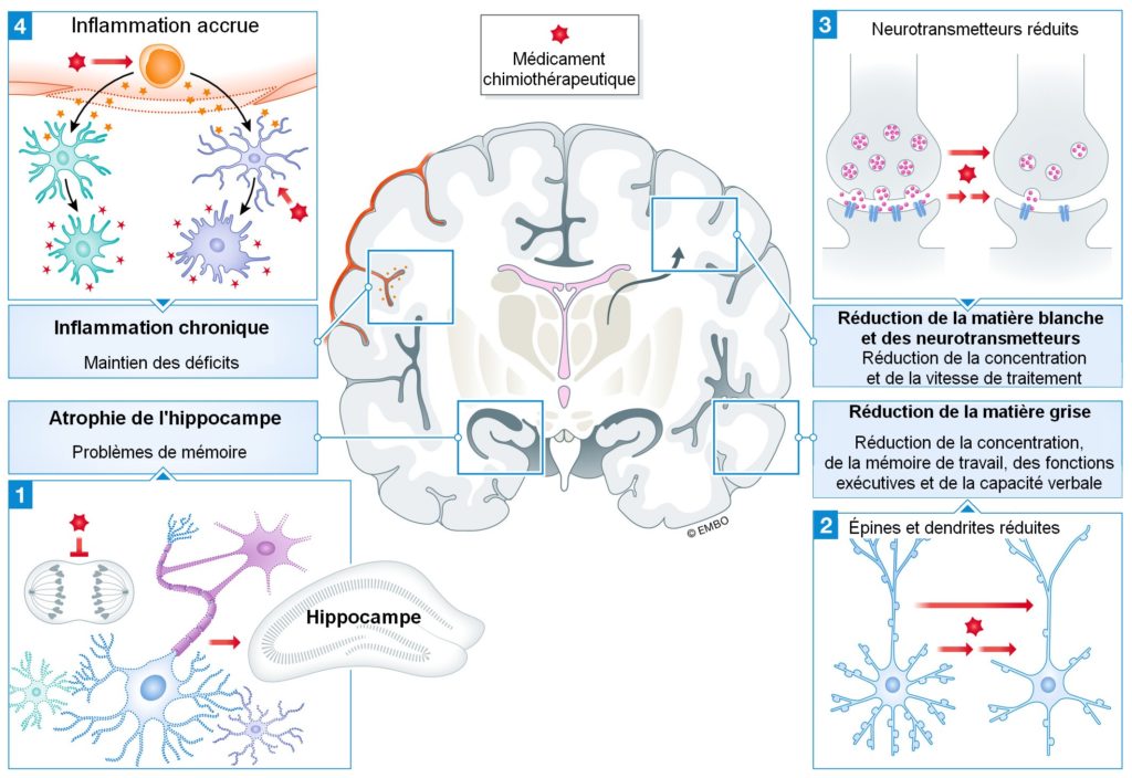 Les effets secondaires de la chimiothérapie sur le cerveau